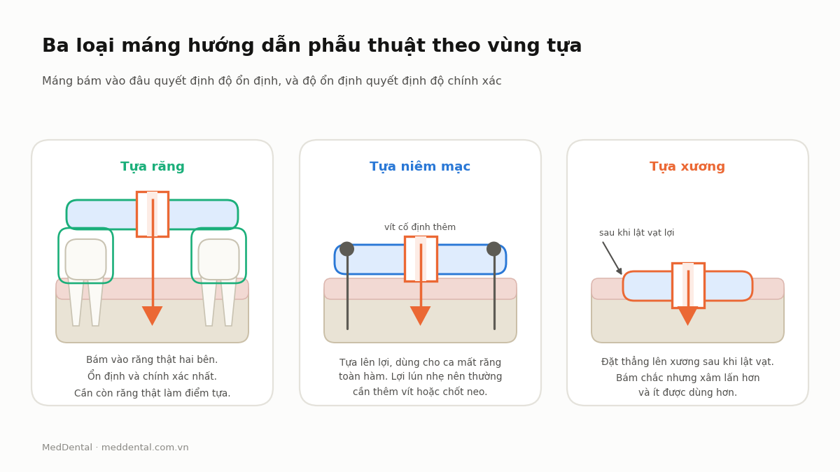 Sơ đồ ba loại máng hướng dẫn phẫu thuật Implant theo vùng tựa