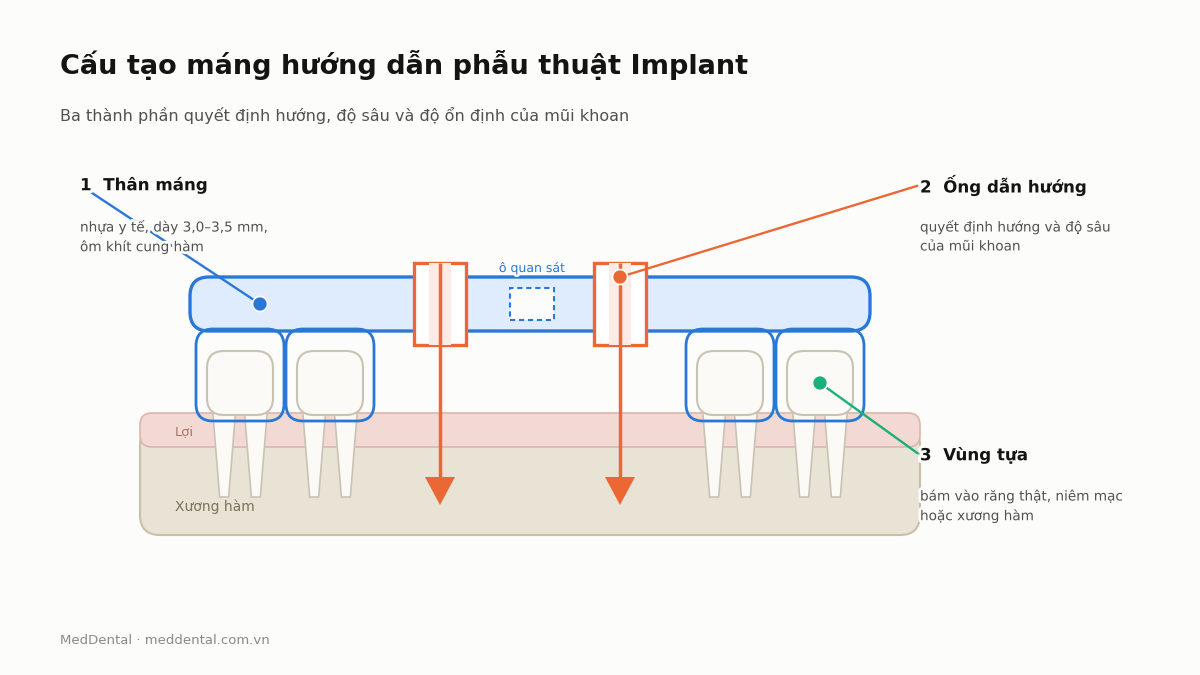 Sơ đồ ba thành phần của máng hướng dẫn phẫu thuật Implant